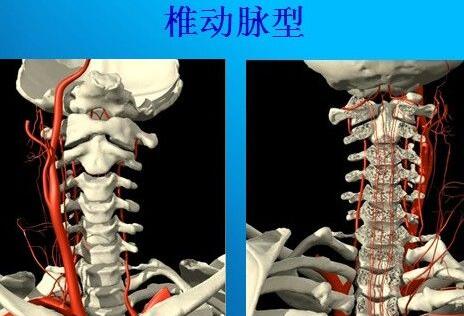 椎動脈型頸椎病診斷標準