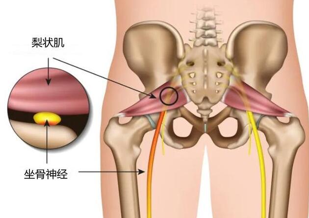 梨狀肌綜合征的最佳治療方法 梨狀肌綜合征的最佳治療方法