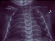 新生兒鎖骨骨折