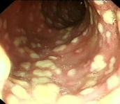假膜性腸炎