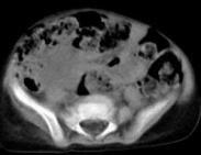 先天性膽總管囊腫