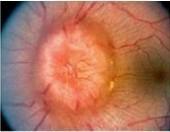 視神經乳頭水腫及視盤水腫