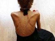 小兒神經(jīng)性厭食