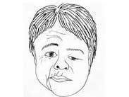 唇舌水腫及面癱綜合征