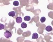 慢性淋巴細胞性白血病