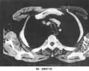 復發性多軟骨炎