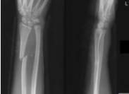 先天性遠端尺橈關(guān)節(jié)半脫位