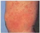 新生兒皮下壞疽